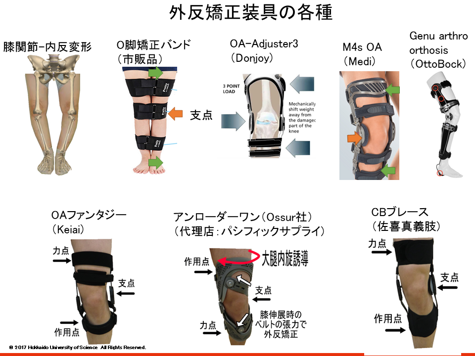 変形性膝関節症に対する評価と装具のバイオメカニズム｜PT-OT-STネット