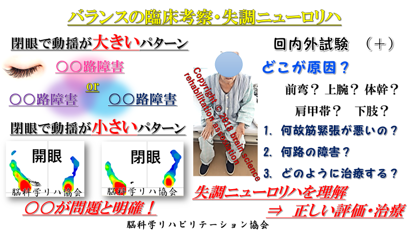 脳科学 脳画像 ｂｒｓ シリーズがオンラインにて実施 Brs 小脳失調治療編 姿勢制御 コアコントロールシステム バランス 筋緊張への解釈 治療方法 Pt Ot St Net