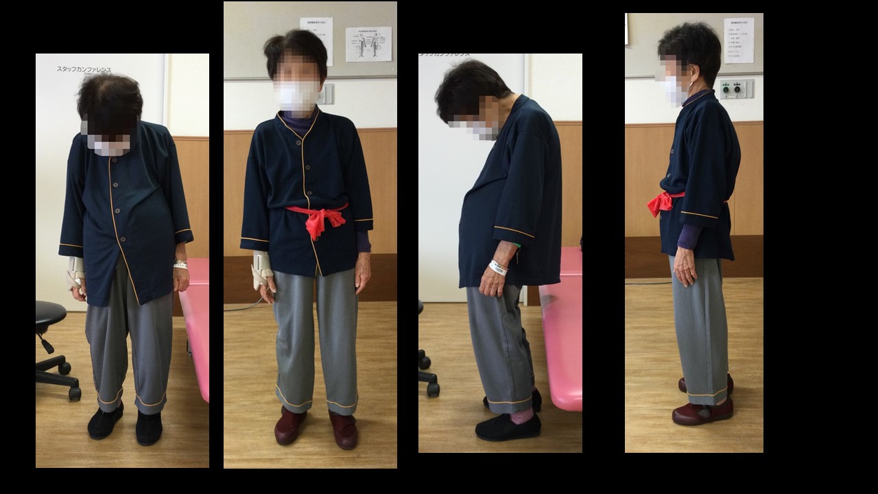 円背腰痛 リハビリ: 運動療法により高齢者の円背姿勢は改善するか – ZEAPST